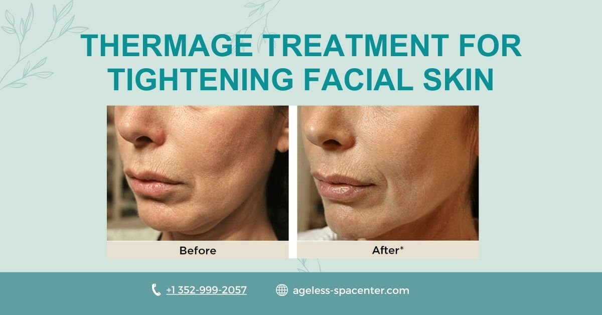 Thermage Treatment for Tightening Facial Skin